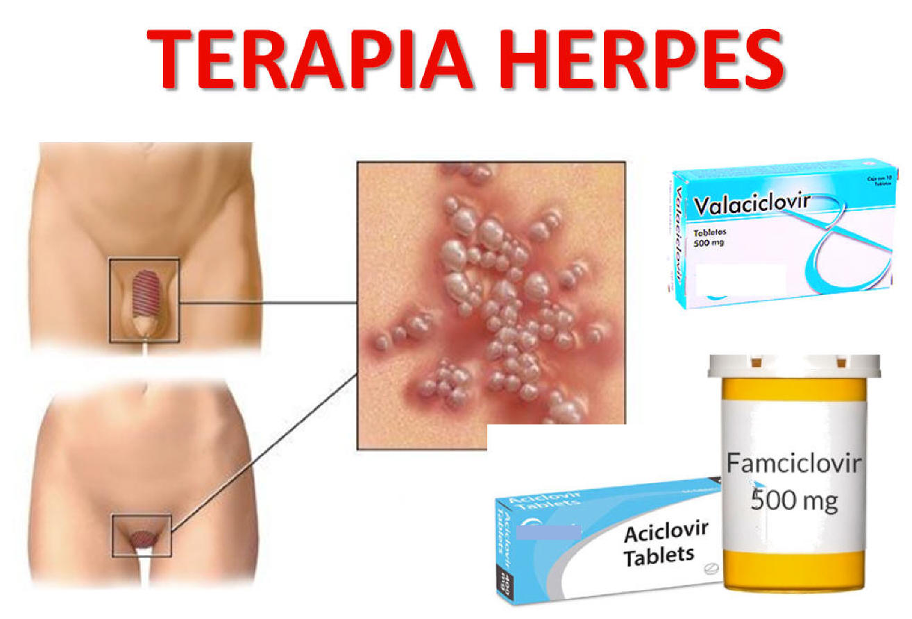 terapia-herpes-esempijpg